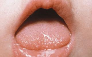 Fehér és átlátszó pattanások a szájban egy felnőtt szájpadlásán