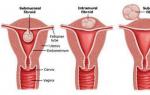 Fibroidler ve hamilelik - uyumlu mu? Bir tümör sürecinin arka planında hamilelik: önemli nüanslar?