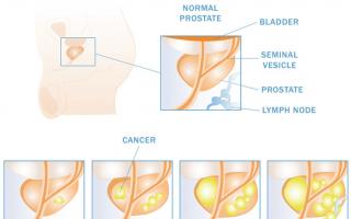 أسباب وأعراض سرطان البروستاتا