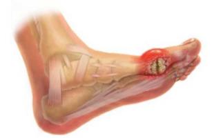 Gout: disease of abundance, symptoms, causes and treatment