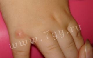 Atopic dermatitis in children: symptoms, treatment, forms of manifestation of the disease Treatment of atopic dermatitis in a 2-year-old child
