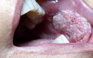 Բերանի խոռոչի քաղցկեղի նշաններն ու ախտանիշները, զարգացման պատճառները. ո՞վ է գտնվում բերանի խոռոչի քաղցկեղի զարգացման վտանգի տակ: