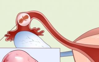 Ինչպե՞ս հղիանալ, եթե արգանդափողերը արգելափակված են: