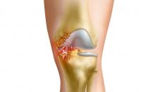 Development of the patella, injuries and their consequences